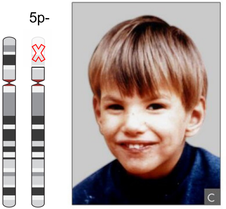 cri du chat mutation and phenotype