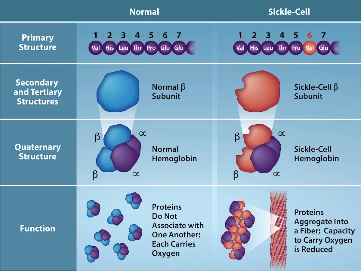 Sickle cell anemia